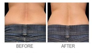 Soraya-laser-hair-removal-Cavitation-cellulite-Anti-again-weightloss-regimen-acne-dermalift-purelight-body-treatment-dermapod- beauty-salon-spa-injectiontreatmen-non-surgical-rejuvenate-skin-facial