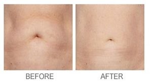 Soraya-laser-hair-removal-Cavitation-cellulite-Anti-again-weightloss-regimen-acne-dermalift-purelight-body-treatment-dermapod- beauty-salon-spa-injectiontreatmen-non-surgical-rejuvenate-skin-facial