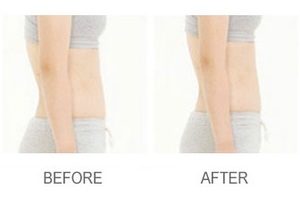 Soraya-laser-hair-removal-Cavitation-cellulite-Anti-again-weightloss-regimen-acne-dermalift-purelight-body-treatment-dermapod- beauty-salon-spa-injectiontreatmen-non-surgical-rejuvenate-skin-facial