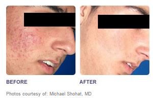 Soraya-laser-hair-removal-Cavitation-cellulite-Anti-again-weightloss-regimen-acne-dermalift-purelight-body-treatment-dermapod- beauty-salon-spa-injectiontreatmen-non-surgical-rejuvenate-skin-facial