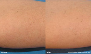 Soraya-laser-hair-removal-Cavitation-cellulite-Anti-again-weightloss-regimen-acne-dermalift-purelight-body-treatment-dermapod- beauty-salon-spa-injectiontreatmen-non-surgical-rejuvenate-skin-facial