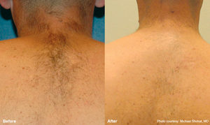 Soraya-laser-hair-removal-Cavitation-cellulite-Anti-again-weightloss-regimen-acne-dermalift-purelight-body-treatment-dermapod- beauty-salon-spa-injectiontreatmen-non-surgical-rejuvenate-skin-facial
