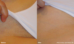 Soraya-laser-hair-removal-Cavitation-cellulite-Anti-again-weightloss-regimen-acne-dermalift-purelight-body-treatment-dermapod- beauty-salon-spa-injectiontreatmen-non-surgical-rejuvenate-skin-facial
