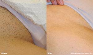 Soraya-laser-hair-removal-Cavitation-cellulite-Anti-again-weightloss-regimen-acne-dermalift-purelight-body-treatment-dermapod- beauty-salon-spa-injectiontreatmen-non-surgical-rejuvenate-skin-facial