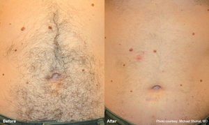 Soraya-laser-hair-removal-Cavitation-cellulite-Anti-again-weightloss-regimen-acne-dermalift-purelight-body-treatment-dermapod- beauty-salon-spa-injectiontreatmen-non-surgical-rejuvenate-skin-facial